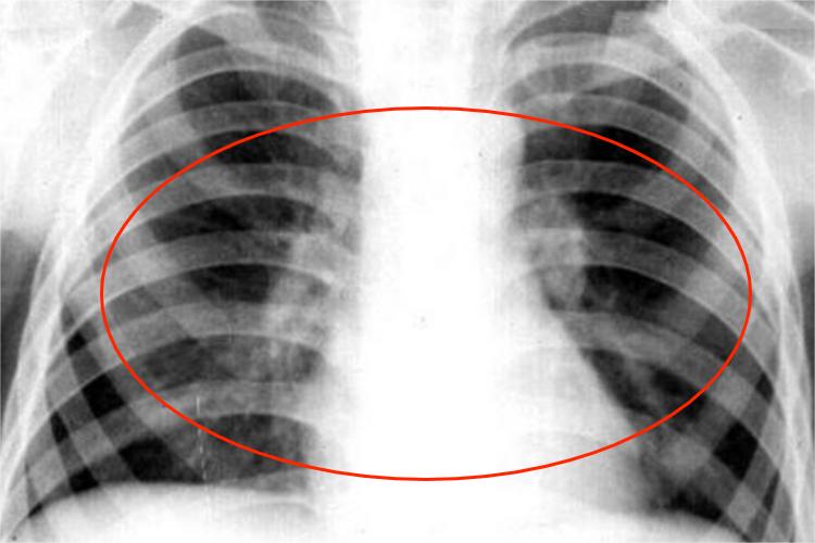 肺结核哑铃状阴影图 肺结核哑铃状阴影图