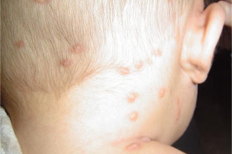 色素性荨麻疹症状图