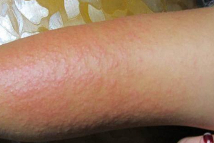 光线性痒疹胳膊小红疙瘩图