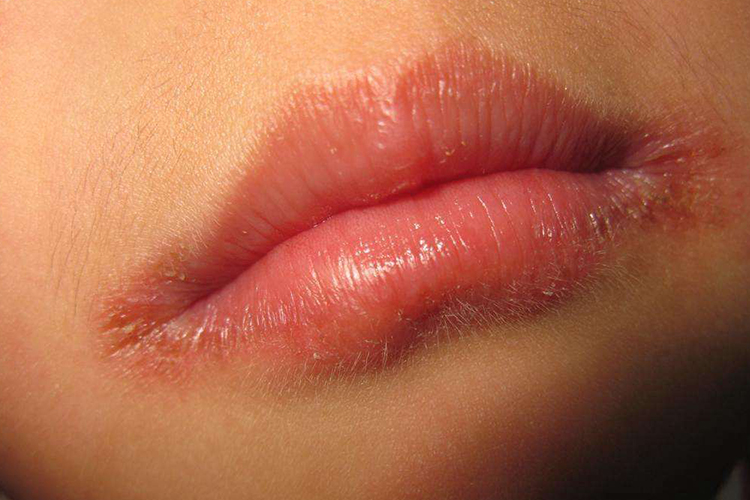 接触性唇炎初期症状图