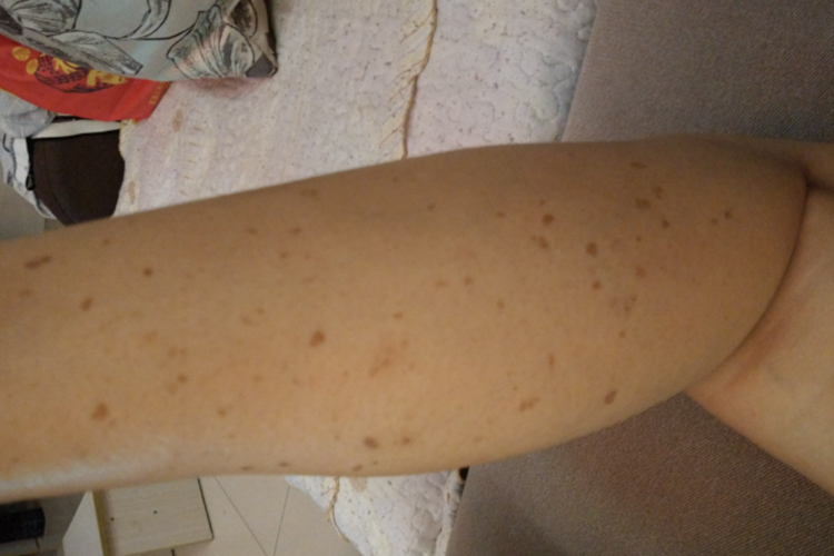 神经纤维瘤病小腿长斑图