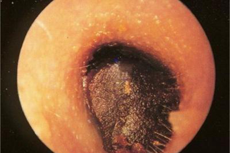 耵聍栓塞外耳道硬块图