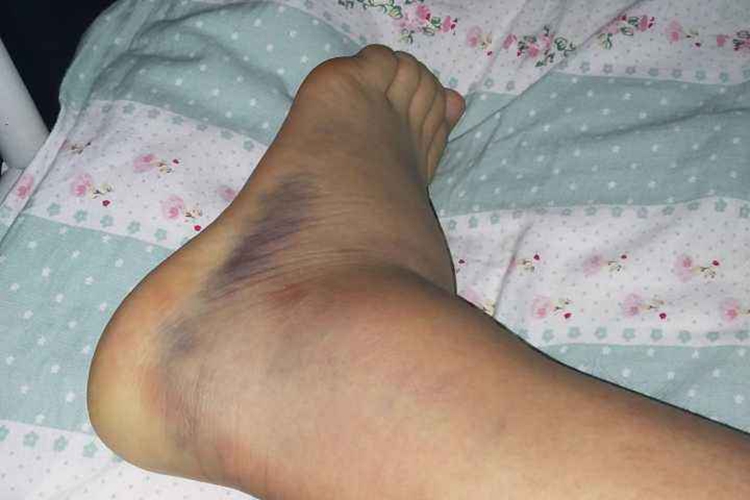 凝血功能障碍脚踝处发紫图