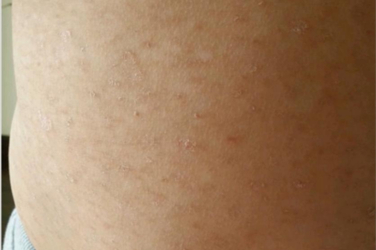 慢性苔藓样糠疹腹部脱屑图
