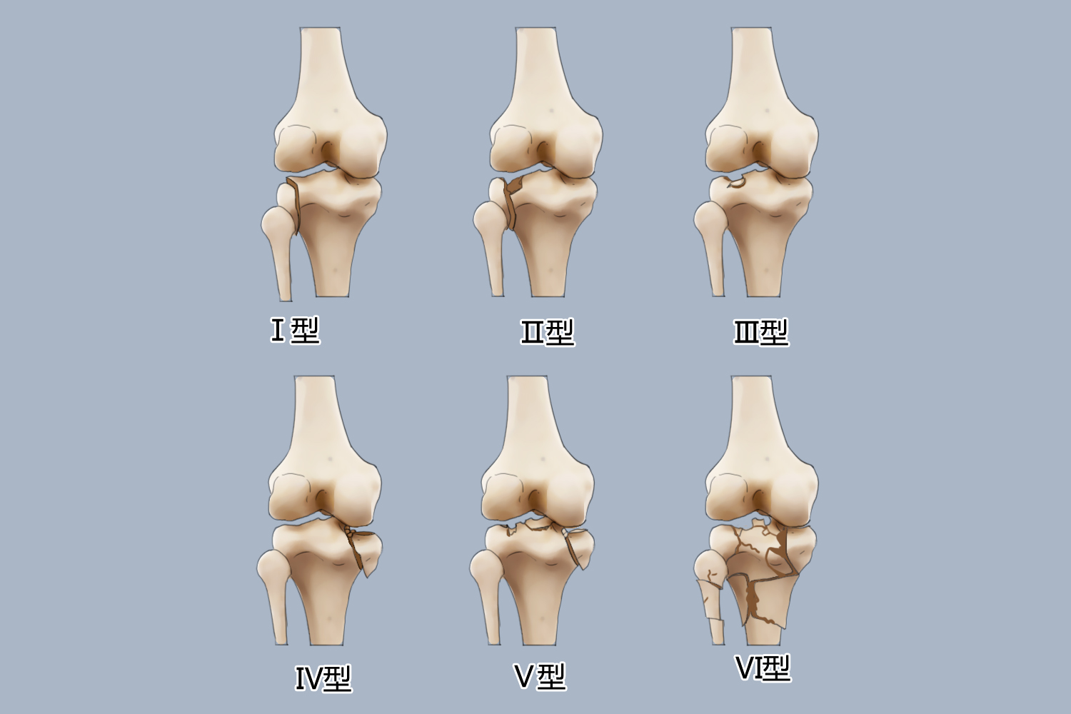 胫骨平台骨折图