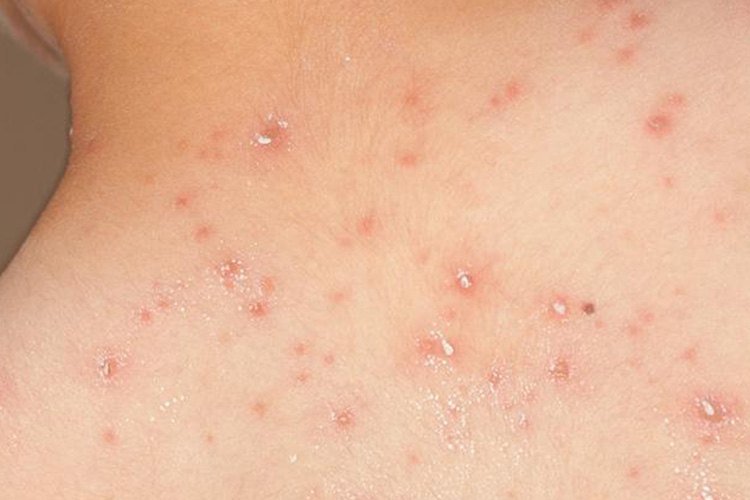 水痘背部结痂图 水痘背部结痂图