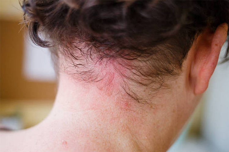 乳胶枕过敏图 乳胶枕过敏图