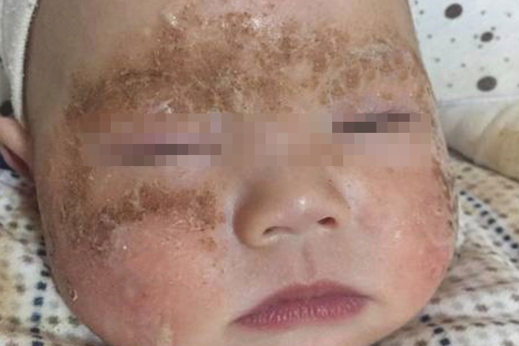 湿疹渗出结痂图