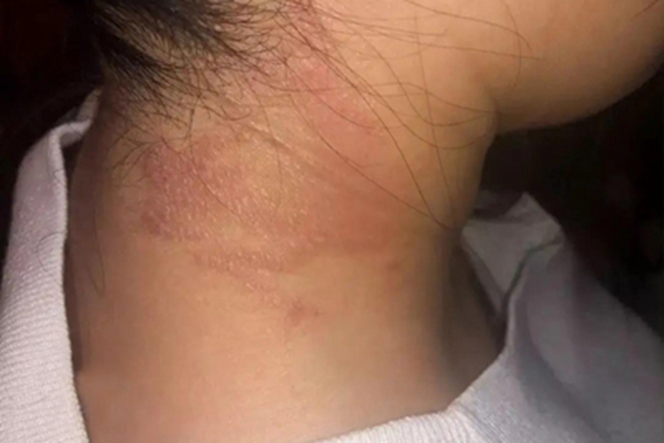 特应性皮炎颈部疙瘩图