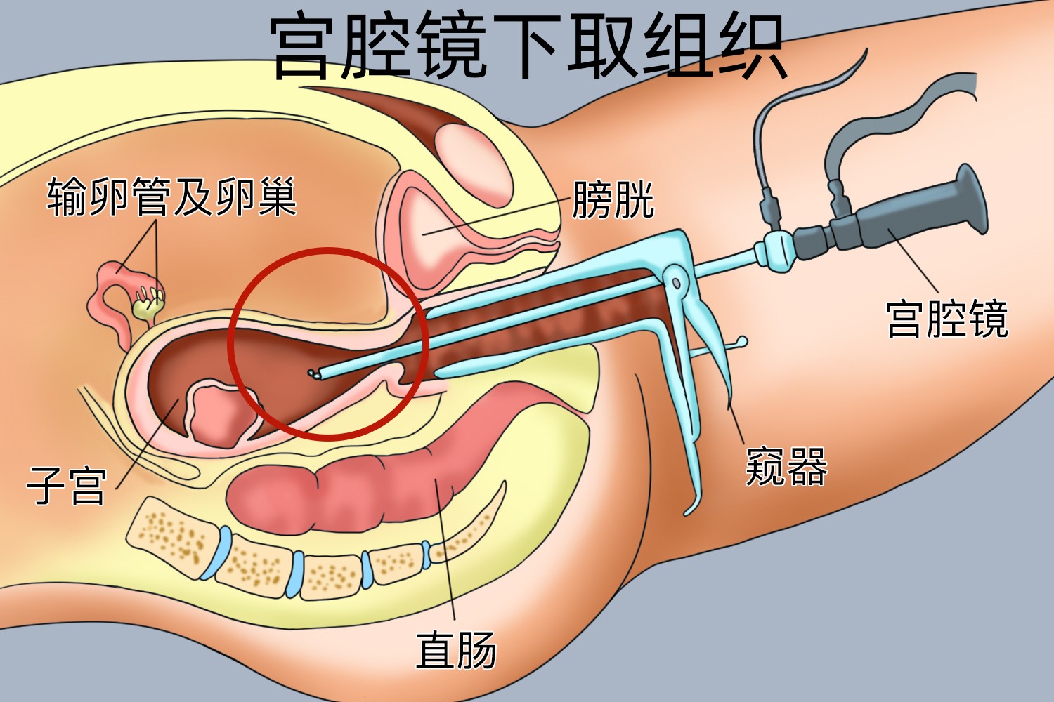 宫腔镜检查图 宫腔镜检查图