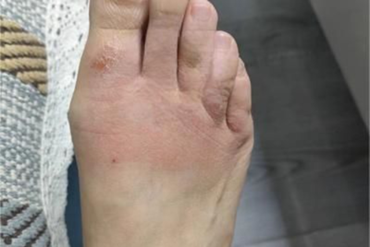 水疱型足癣脚上红肿结痂图 水疱型足癣脚上红肿结痂图