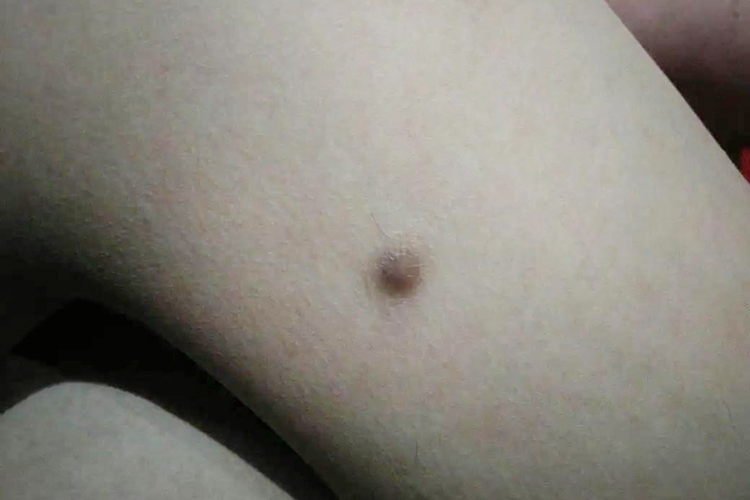 腿上长黑色皮肤纤维瘤图