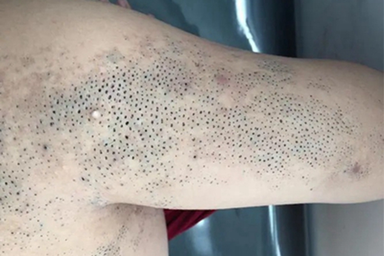 黑头粉刺痣上臂症状图