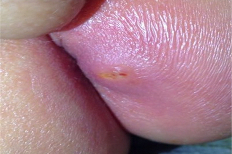 肛门脓肿包块图