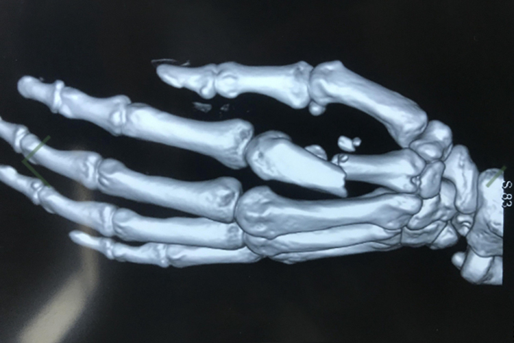 拳击手骨折影像图 拳击手骨折影像图