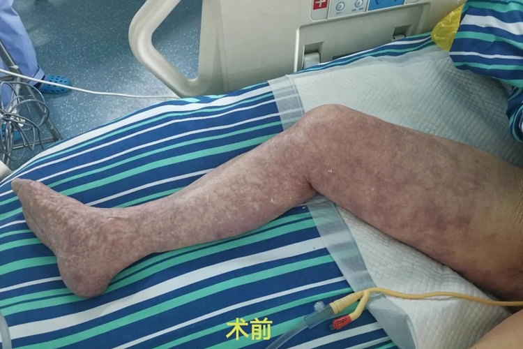 大腿动脉血栓图