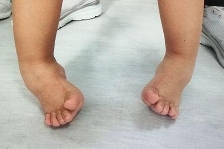 马蹄内翻足图 马蹄内翻足图