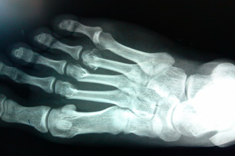 第二三四跖骨骨折图