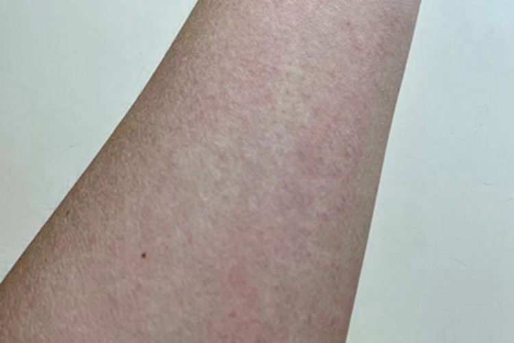 成人Still病胳膊症状图 成人Still病胳膊症状图