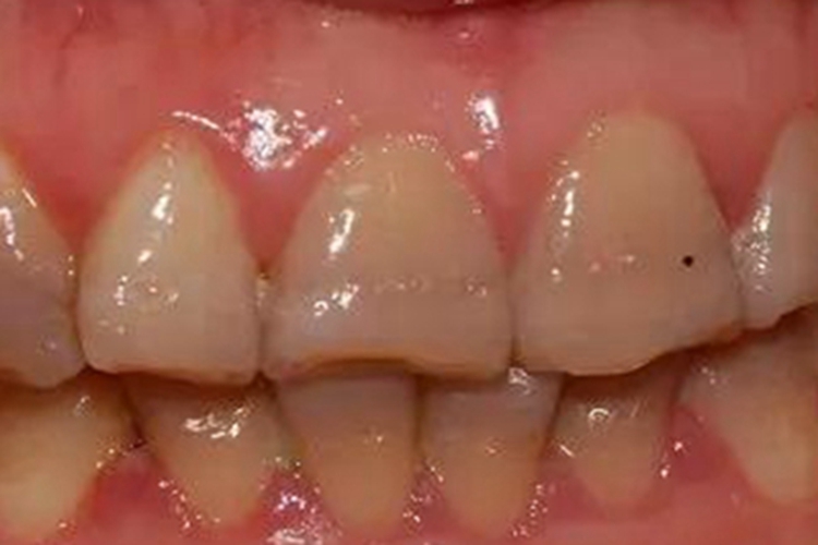 牙釉质发育不全牙齿纹图