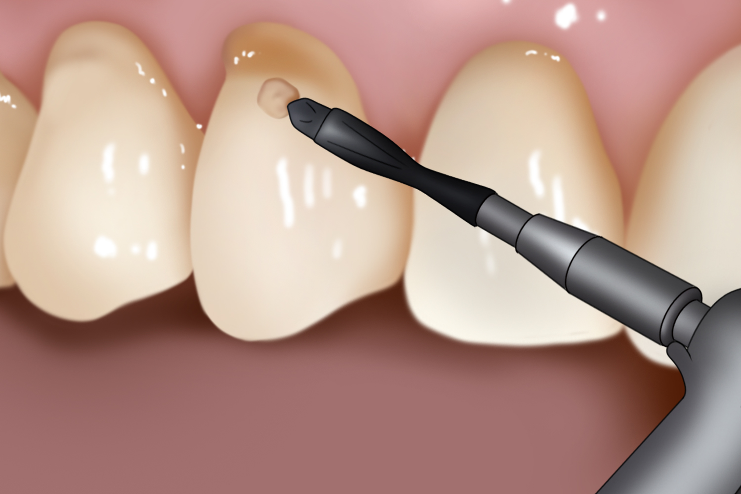 制备洞形图 制备洞形图