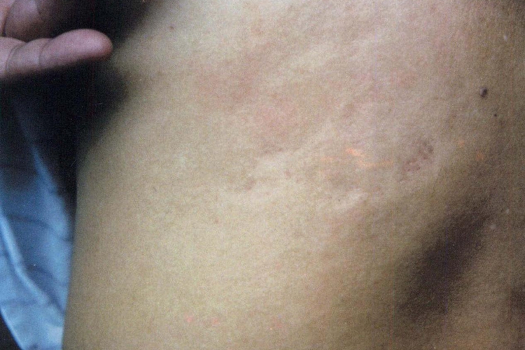 斑状皮肤萎缩图 斑状皮肤萎缩图