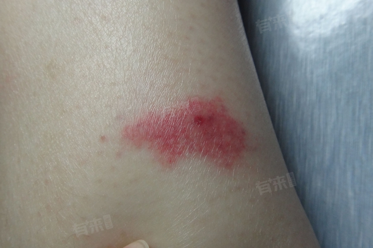 肥皂和清水轻柔地清洗受伤部位,以去除可能残留在皮肤上的毛刺或毒液
