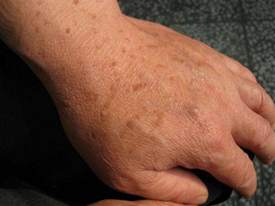 持久性豆状角化过度病的症状和图片 - 有来医生