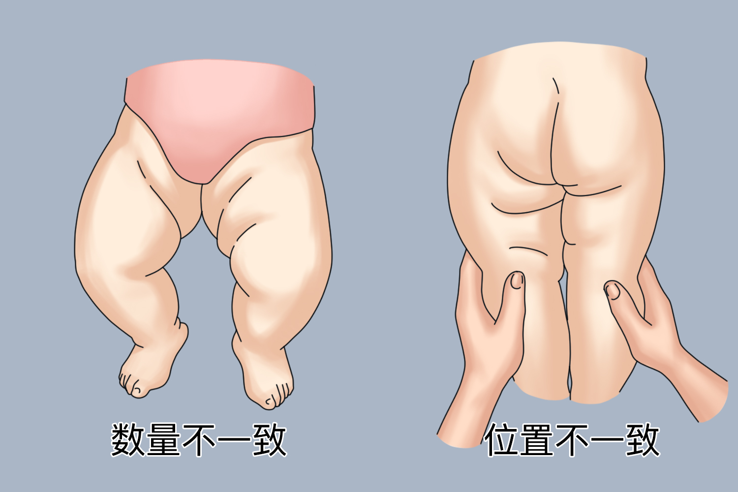 判断宝宝腿纹不对称图图片