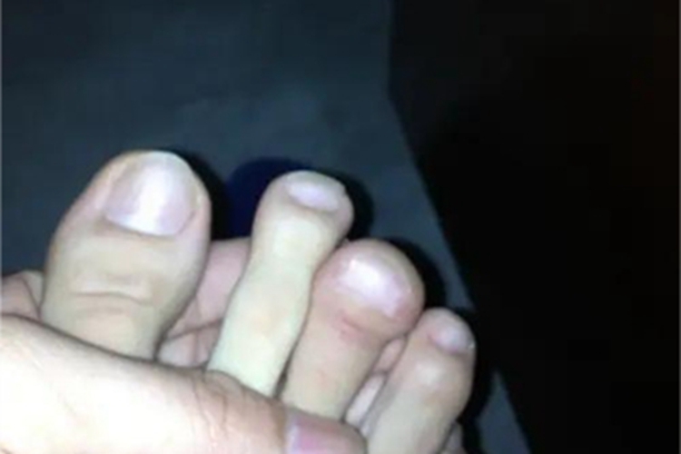 杵状指脚趾症状图 杵状指脚趾症状图