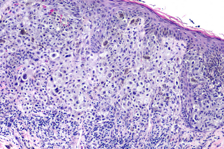 黑色素瘤病理图
