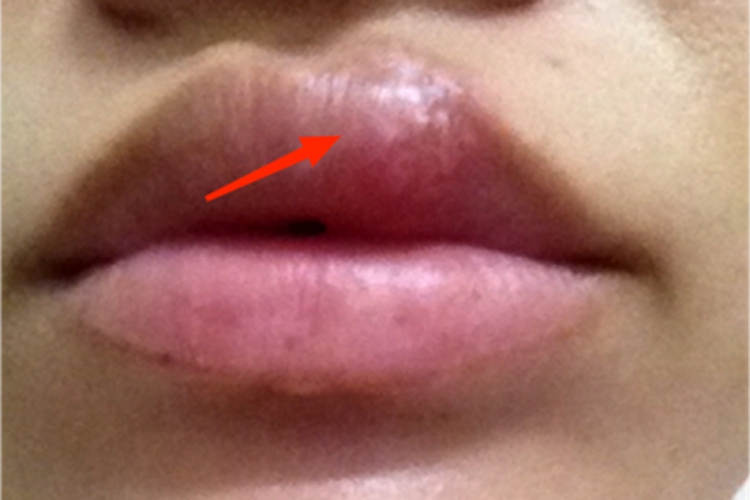 唇疱疹初期上唇长小水疱图