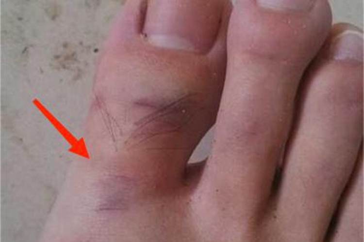 小螺菌型鼠咬热脚趾症状图