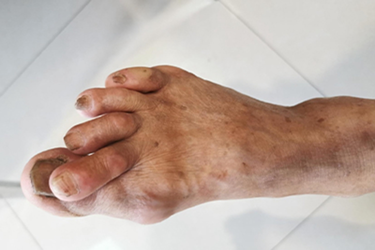 类风湿关节炎脚趾畸形图 类风湿关节炎脚趾畸形图