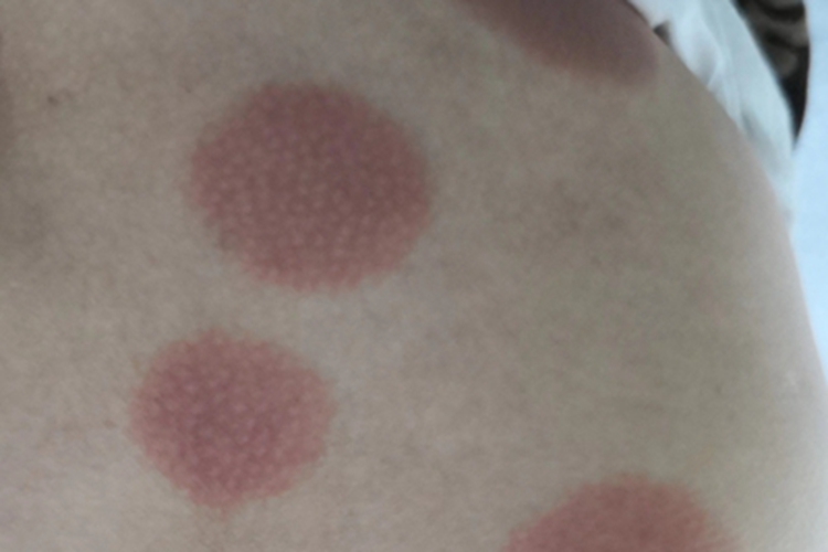 固定型药疹背部症状图 固定型药疹背部症状图