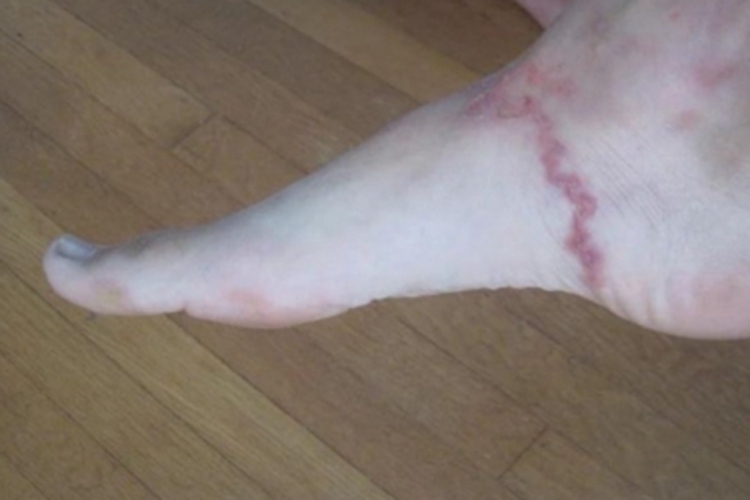 钩虫皮炎脚上一条线图