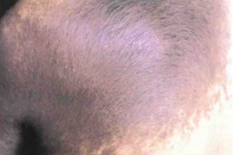 贝克痣背部症状图