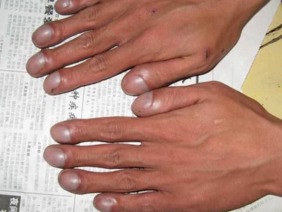 杵状指手指甲变宽变大图