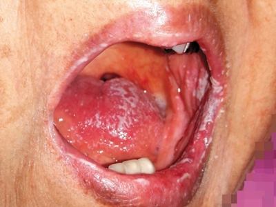 艾滋病期嘴角和舌头上有白斑图.jpeg