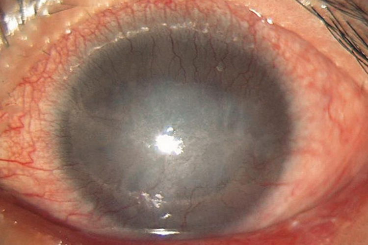 沙眼晚期图 沙眼晚期图