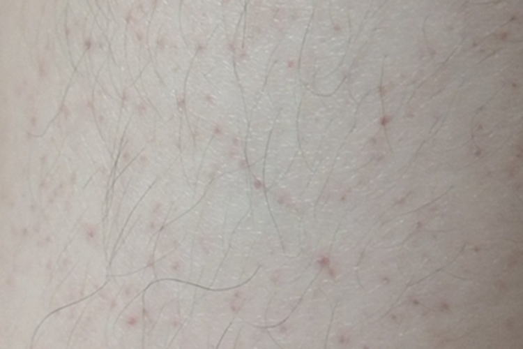 毛囊炎大腿红点图