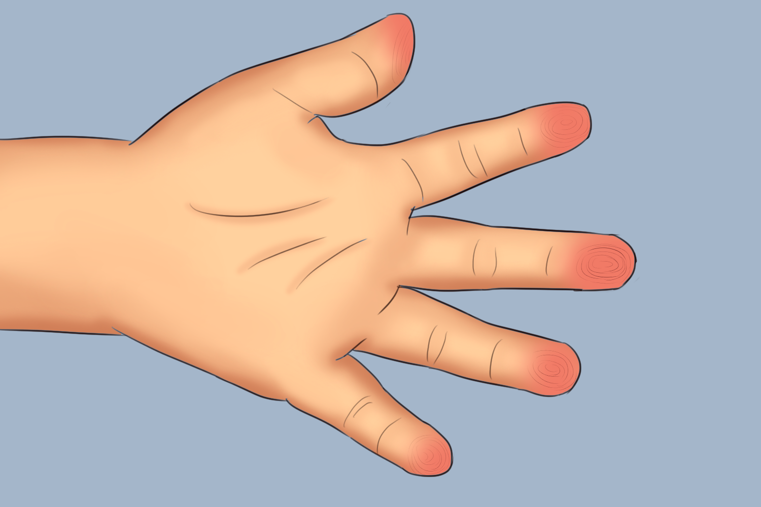 小儿指纹偏红 小儿指纹偏红