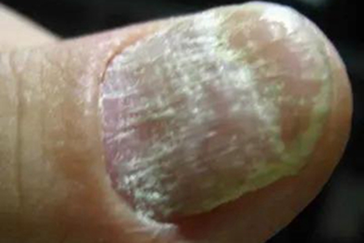 念珠菌性甲真菌病手指甲症状图