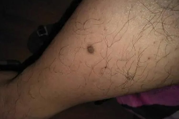 丘疹性血管角化瘤图