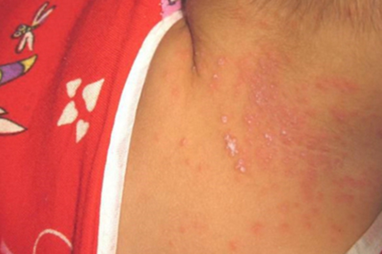 慢性黏膜皮肤念珠菌病颈部丘疹图 慢性黏膜皮肤念珠菌病颈部丘疹图