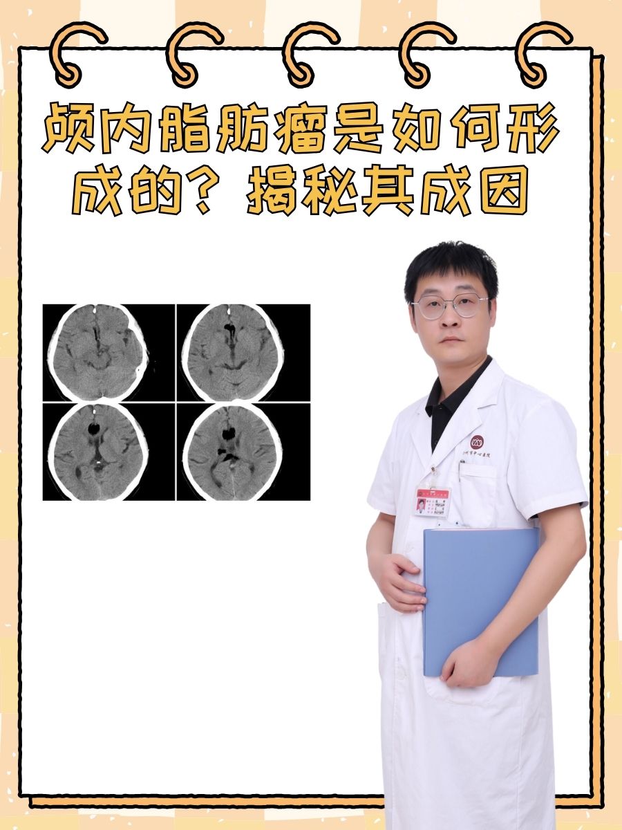 颅内脂肪瘤是如何形成的？揭秘其成因