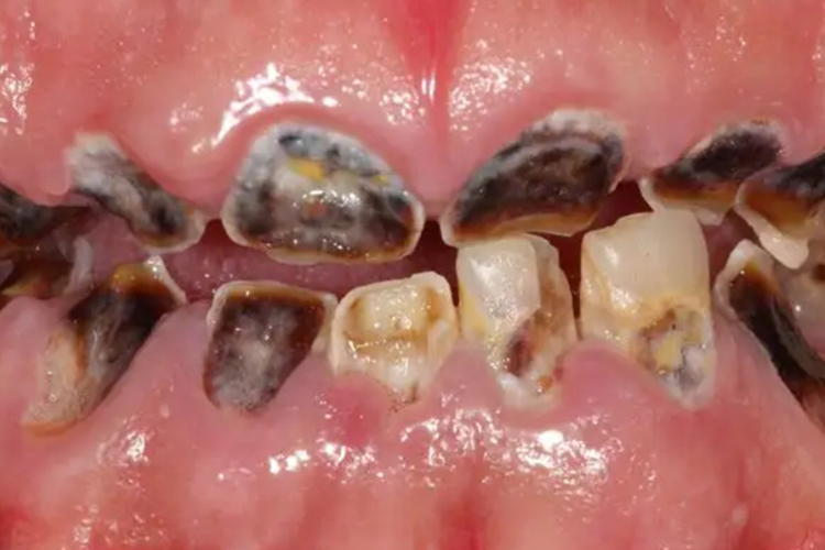 门牙大面积腐烂缺损图 门牙大面积腐烂缺损图