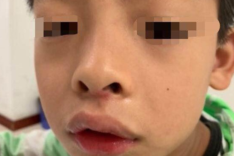 腺样体面容上切牙突出图