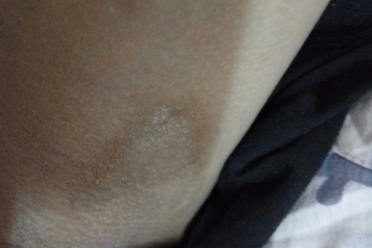 女生股癣色素沉着图