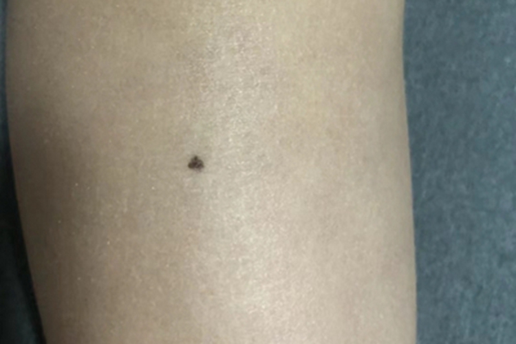 交界痣小腿上有黑色痣图 交界痣小腿上有黑色痣图